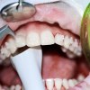Halb geöffneter Mund mit Behandlungsinstrumenten