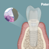 Zeichnung eines Querschnitts eines Implantats