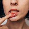 Frau hält mit Finger die untere Lippe herunter, zeigt Zahnfleischentzündung. Man sieht nur den halben Kopf und etwas Hals und Schultern