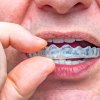 Mann setzt halbtransparente Zahnschiene ein