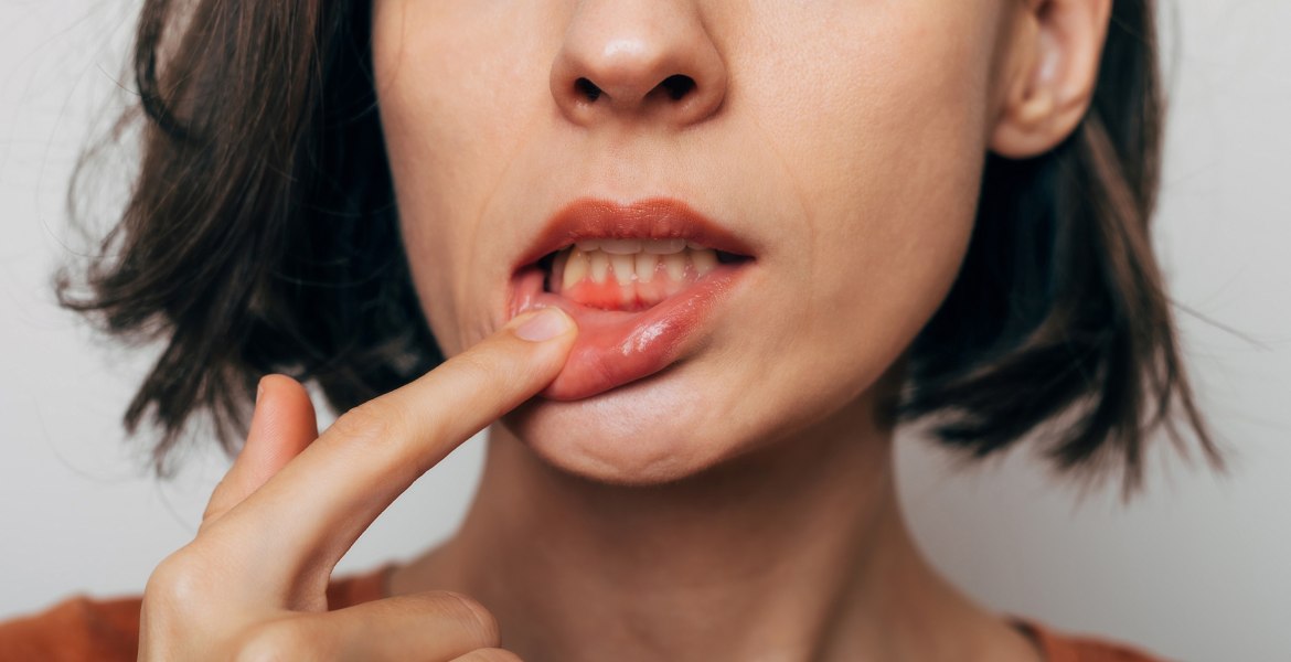 Frau hält mit Finger die untere Lippe herunter, zeigt Zahnfleischentzündung. Man sieht nur den halben Kopf und etwas Hals und Schultern