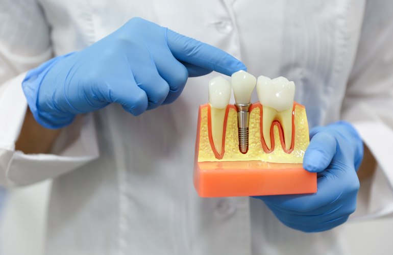 Modell eines implatantierten Zahnes in der Hand eines Zahnarztes